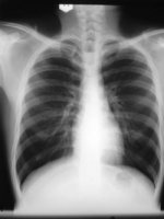 BTMH_COPD_image_generic_chest_x-ray_normal.jpg